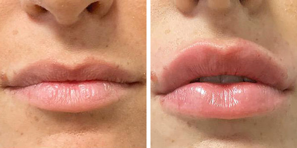 Valeria – filler labbra – Tempesta