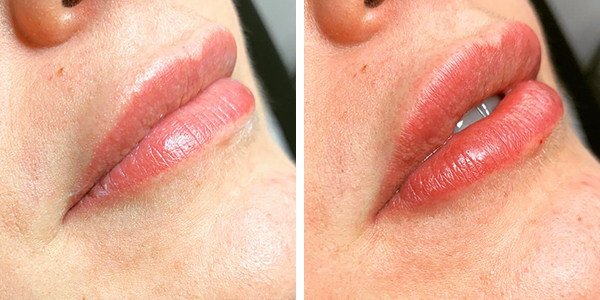 Carla – filler labbra – Tempesta
