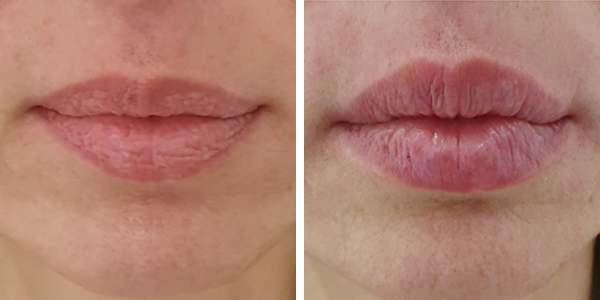 Anna – filler labbra – Feltri
