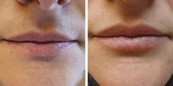 Simona – filler labbra – Feltri