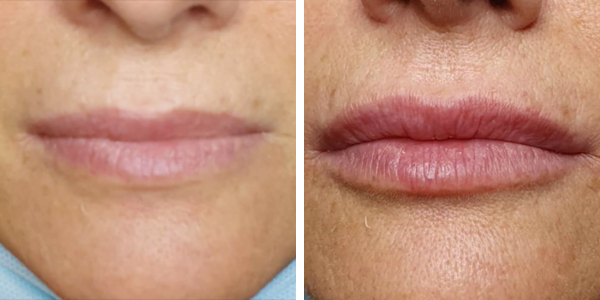 Cinzia – filler labbra – Feltri