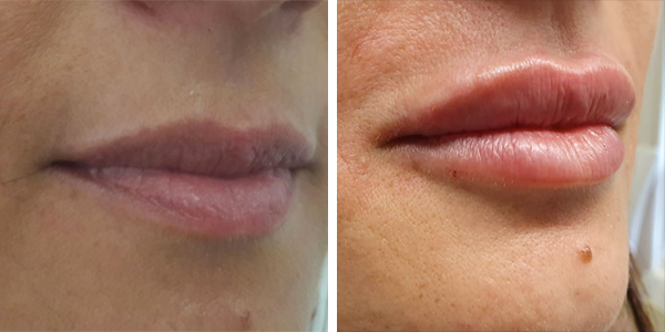 Giovanna – filler labbra – Feltri