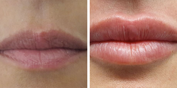 Benedetta – filler labbra – Feltri