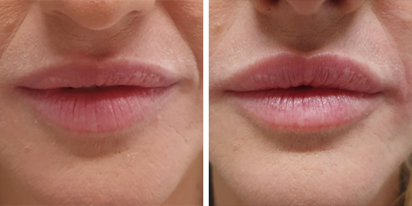 Marta – filler labbra – Feltri