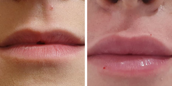 Lucia – filler labbra – Feltri
