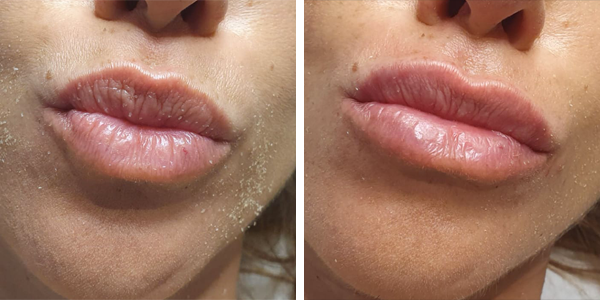 Claudia – filler labbra – Feltri