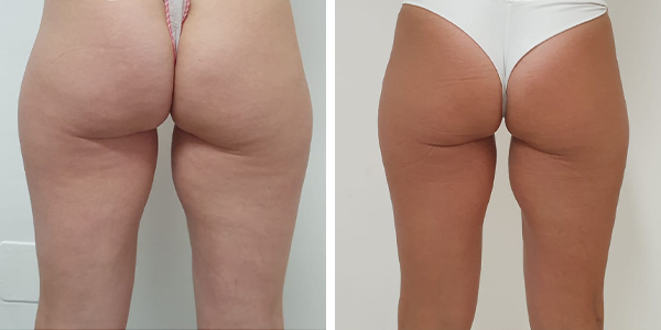 Luisa – criolipolisi – Feltri