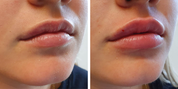 Irene – filler labbra – Feltri
