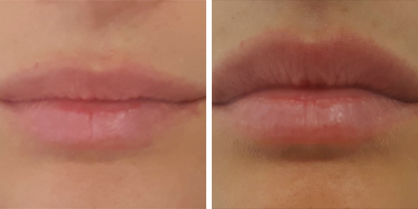 Vanessa – filler labbra – Feltri