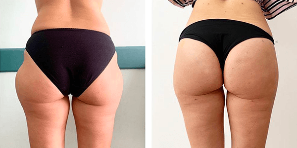 Roberta – liposcultura – Tempesta