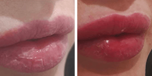 Gioia – filler labbra – Prezzemoli