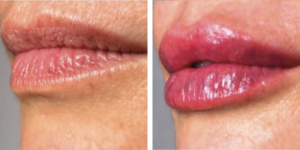 Silvia – filler labbra – Aracena