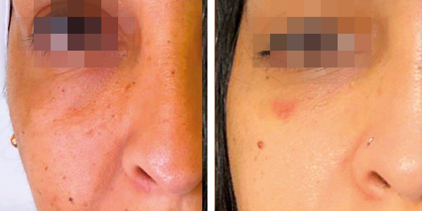 Tania – filler occhiaie – Aracena