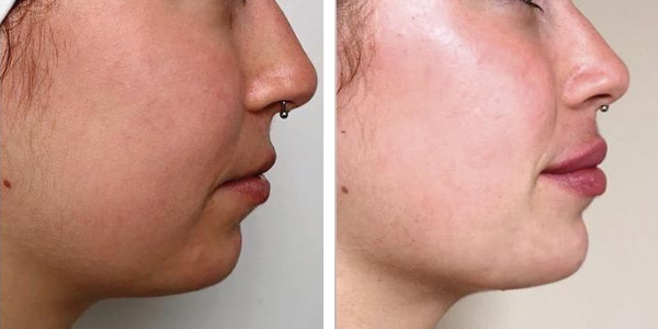 Carolina – filler labbra – Aracena