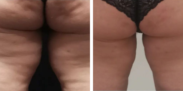 Cristiana – endolift – Garkavaya