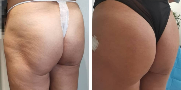 Romina – filler glutei – Garkavaya