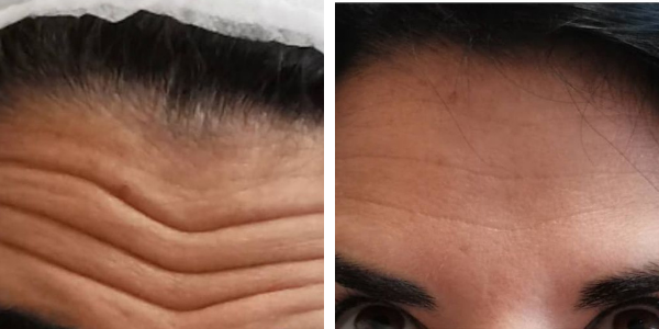 Clara – botox – Garkavaya