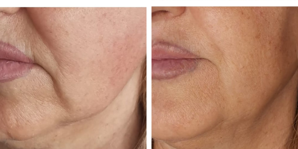 Gemma – endolift viso – Garkavaya