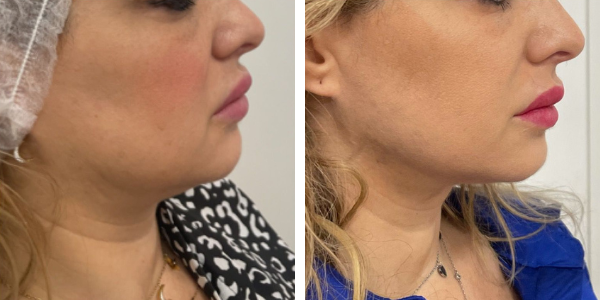 Maria – endolifting viso – Dott.ssa Dedova