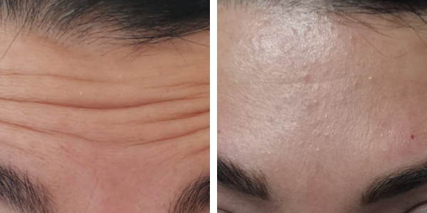Flavia – botox – Garkavaya
