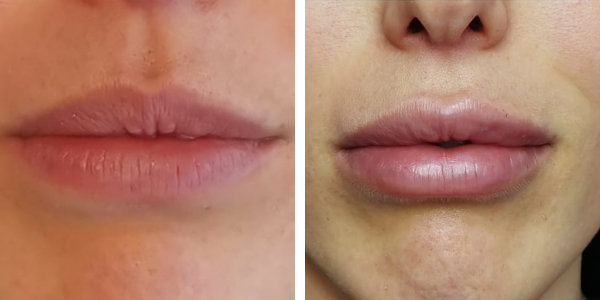 Azzurra – filler labbra – Garkavaya