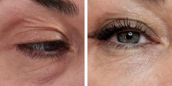 Marianna – Filler Occhiaie – Dott. Lolla