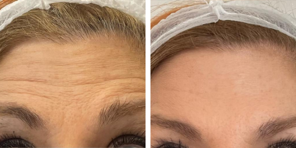 Maria – Botox – Dott.ssa Aracena