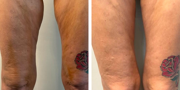 Annarita – Endolift – Dott. Aracena