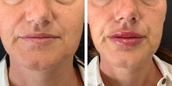 Barbara – Filler Labbra – Dott. Costantino