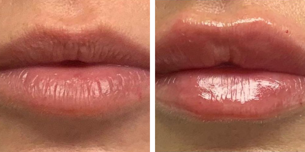 Sandra – Filler Labbra – Dott.ssa Ilari