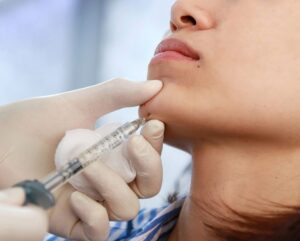 filler mento, donna si sottopone a trattamento